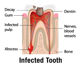 root-canal-treatment-dentist-jamaica-queens